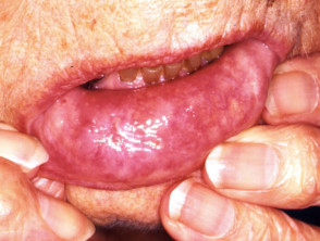 Lip ulceration due to granulomatosis with polyangiitis
