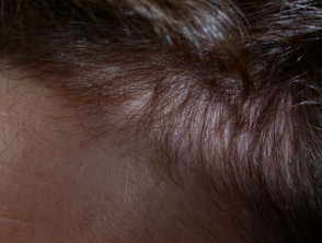 Telogen effluvium (hair shedding) | DermNet