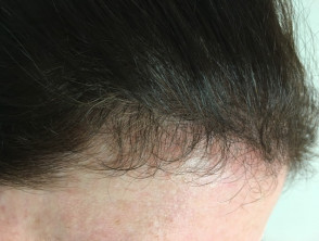 Diffuse alopecia | DermNet
