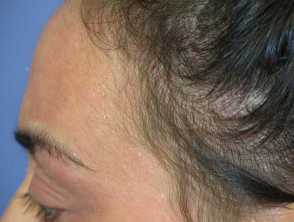 Telogen effluvium (hair shedding) | DermNet