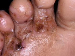 Infected tinea pedis