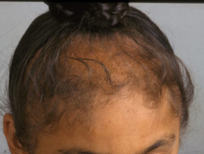 Hair Loss – Understanding Scarring vs. Non-Scarring Alopecias | The Skin  Skoop