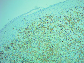Transformed mycosis fungoides pathology stained with CD3 x100