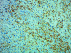 Transformed mycosis fungoides pathology stained with CD4 x200