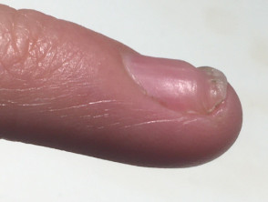 Transverse groove in nail
