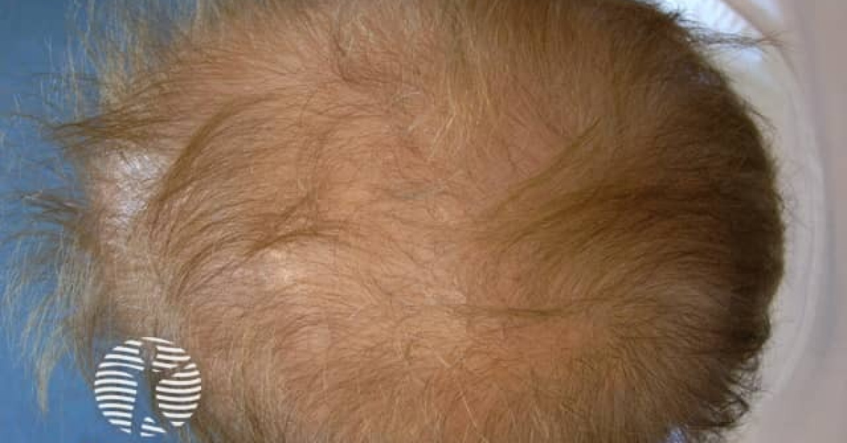 Acitretin diffuse hair loss image
