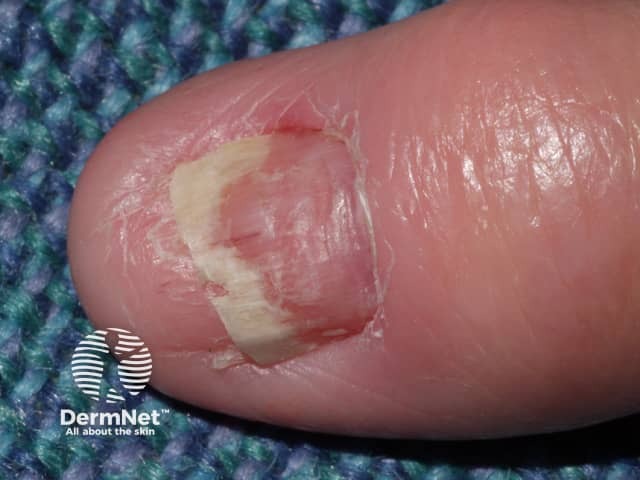 Nail plate deformity induced by acitretin