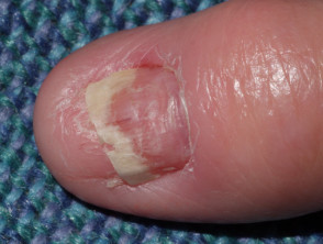 Drug-induced nail disease | DermNet