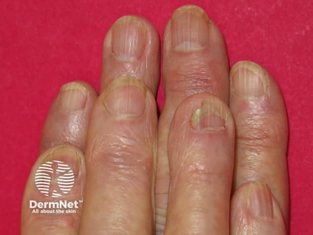 Acitretin nail thinning