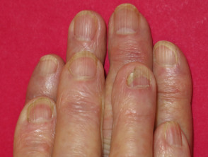 Acitretin nail thinning