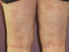 Psoriasis 6 months after commencing adalimumab