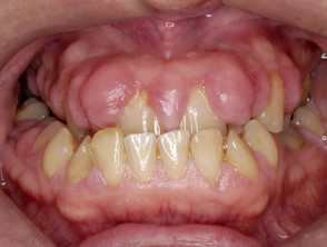 Gum hypertrophy due to ciclosporin