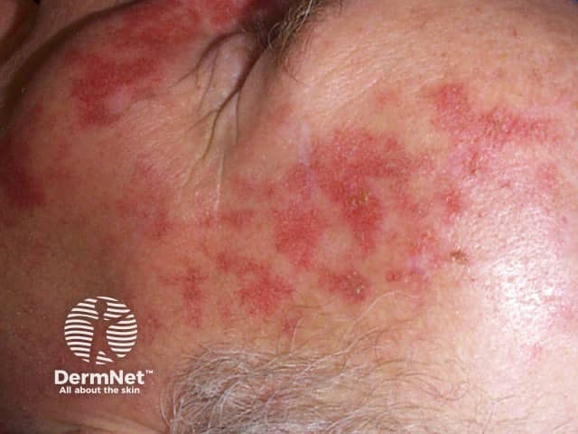 Keratoses after 2 weeks' treatment