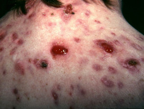 Granulomas provoked by isotretinoin