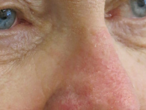 Effects of ingenol mebutate gel on facial actinic keratoses