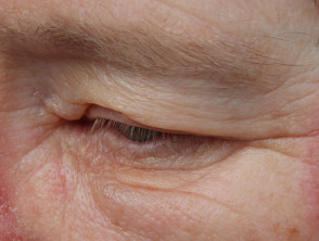 Eyelid swelling from ingenol mebutate gel