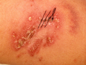 Localised pustular psoriasis induced by superpotent topical steroid