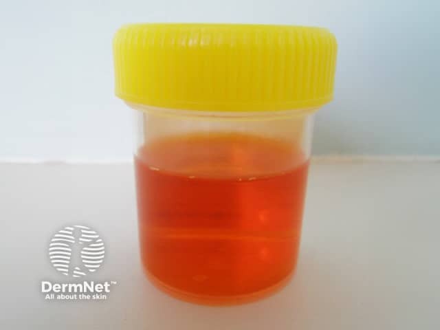Discoloured urine on rifampicin