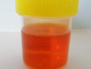 Discoloured urine on rifampicin