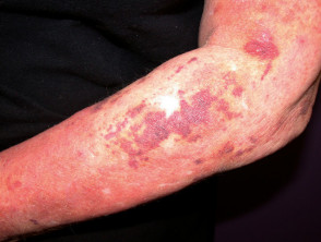 Bruising due to topical steroids