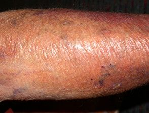 Skin thinning from topical steroids
