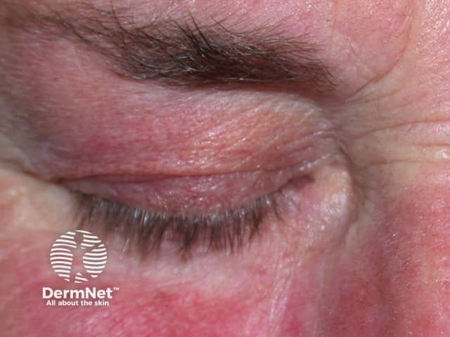 Redness and swelling of the lids - steroid withdrawal after prolonged potent steroid use on the face.