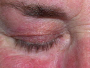 Prominent capillaries due to topical steroids