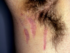 Stretch marks due to topical steroids