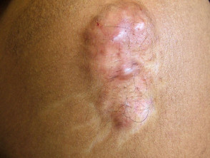 Lipoatrophy due to intralesional steroid injection