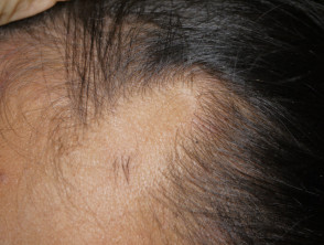 Temporal Triangular Alopecia — DermNet
