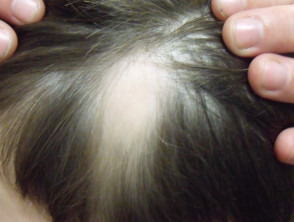 Triangular temporal alopecia