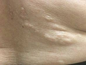 Tuberous sclerosis shagreen patch