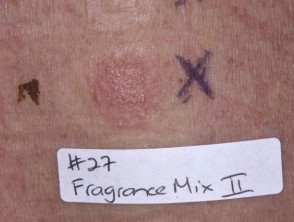 Positive patch test to fragrance