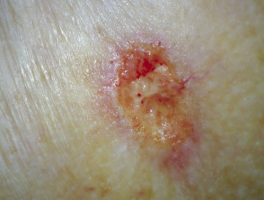 Ulcerating basal cell carcinoma, arm