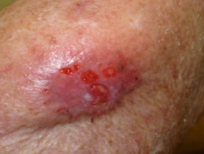 Ulcerating basal cell carcinoma, elbow
