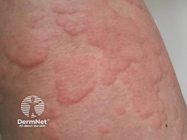 Acute Urticaria Causes Features And Treatment DermNet