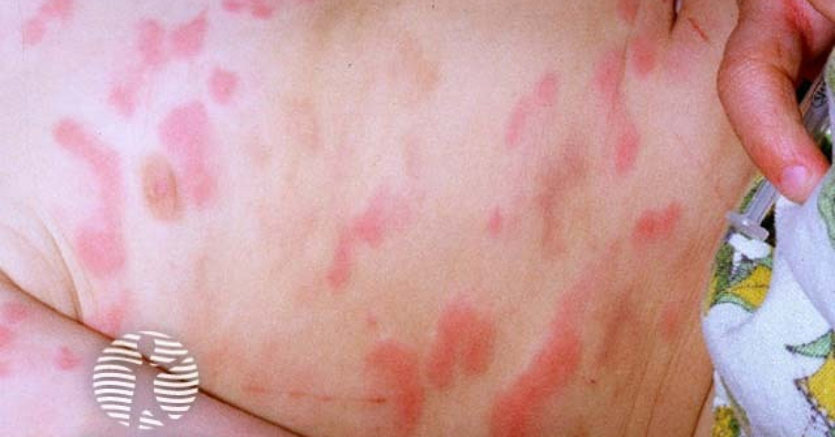 Uticarial Rash. Children Urticaria in a child image