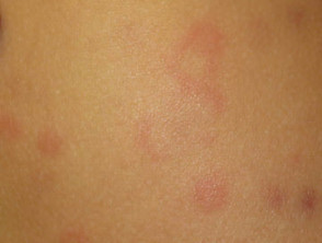 Urticaria (Hives) - Dermatologist In Chino Hills, CA