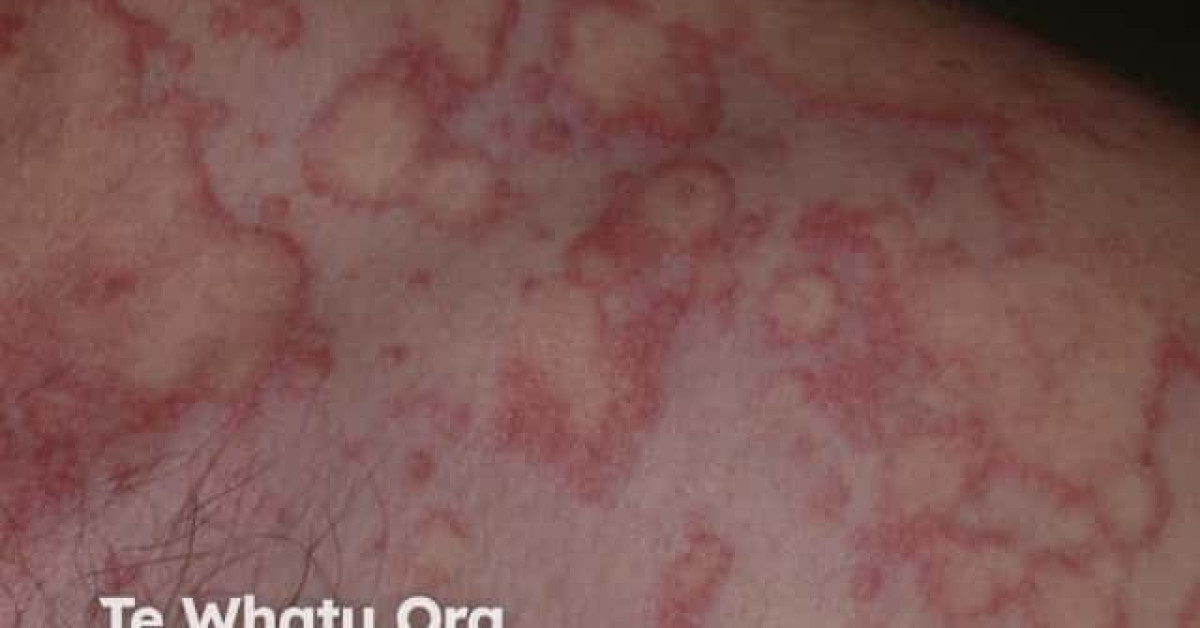 Spontaneous urticaria image