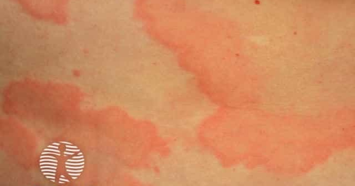 spontaneous-urticaria-image