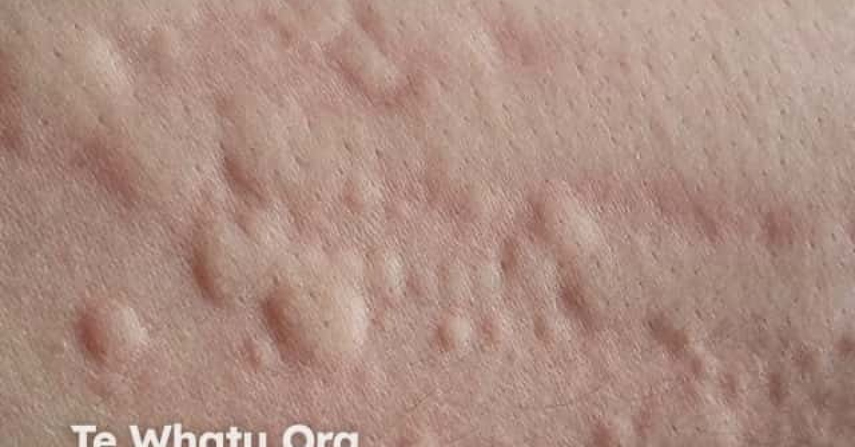 Dermographic urticaria image