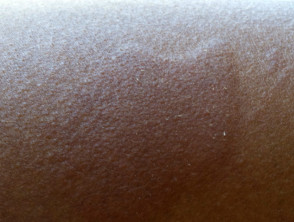 Urticaria in dark skin
