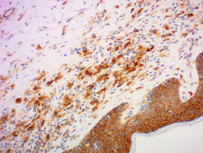Urticaria pigmentosa pathology stained with CD117 x200