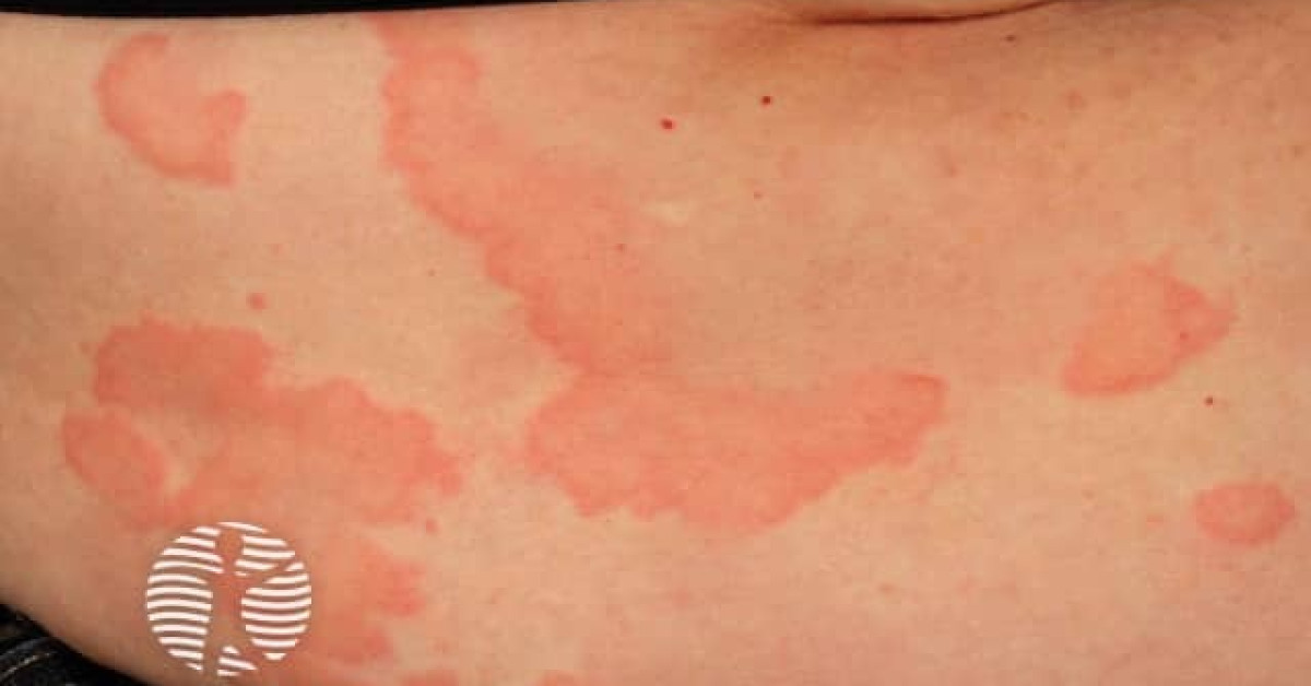 Urticaria image