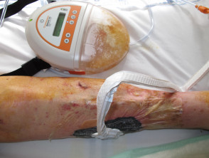Wound undergoing treatment with negative-pressure device
