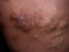 Varicose veins and varicose eczema