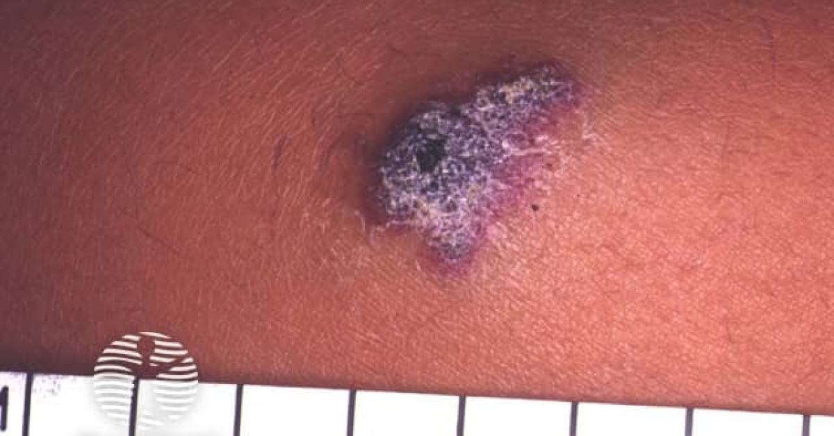 Angiokeratoma image