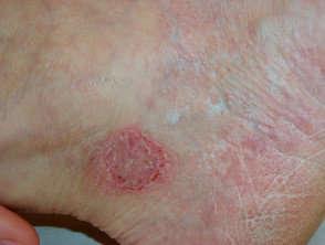 Atrophie blanche adjacent to discoid eczema