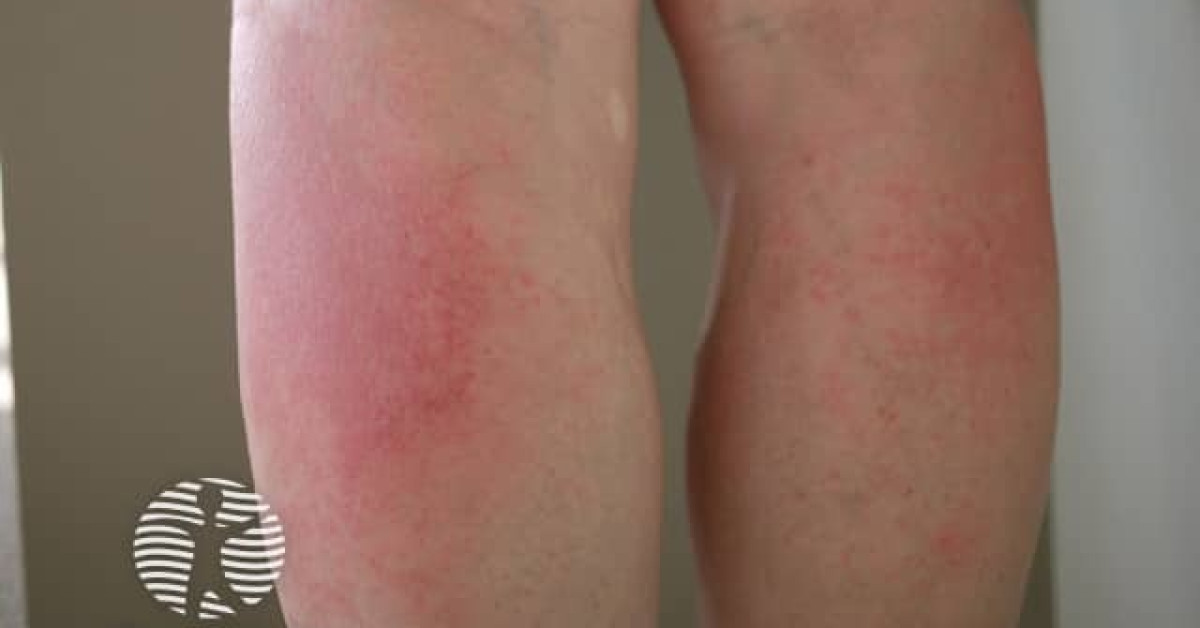 Exerciseinduced vasculitis image