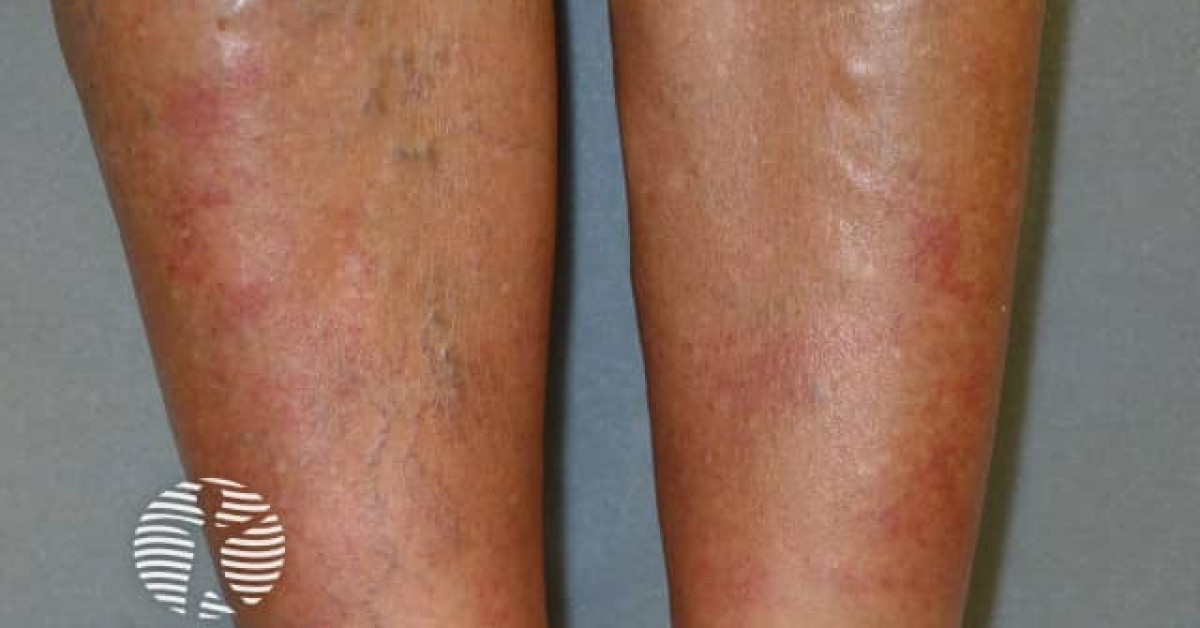 Exerciseinduced vasculitis image